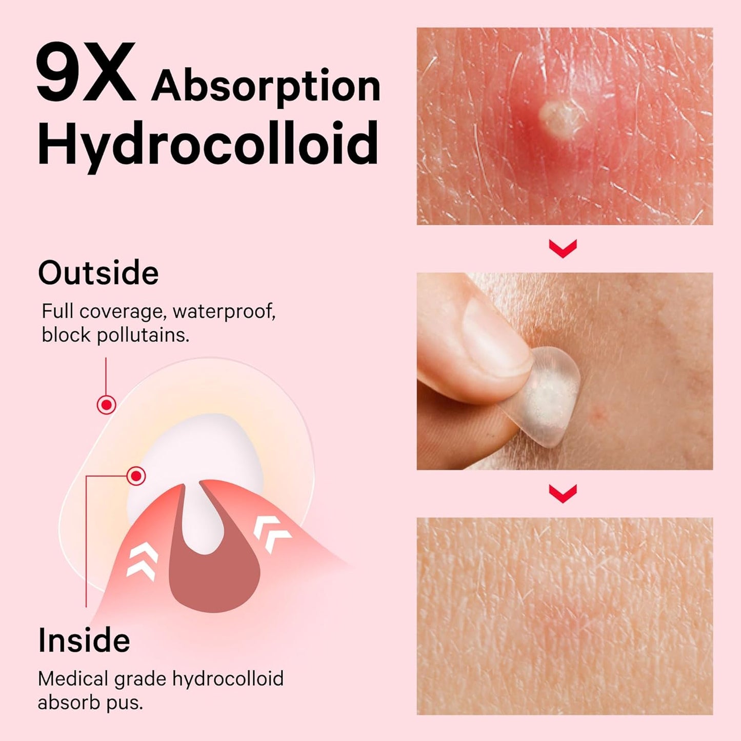 Acne™ Pimple Patch 72 Pcs