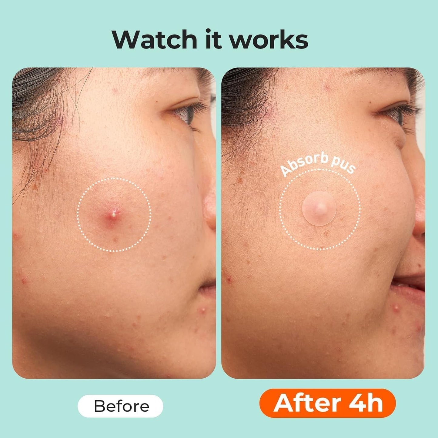 Acne™ Pimple Patch 72 Pcs