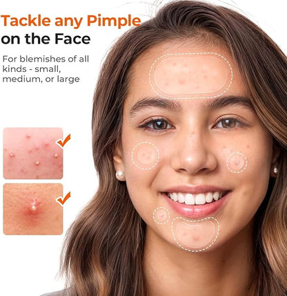 Acne™ Pimple Patch 72 Pcs