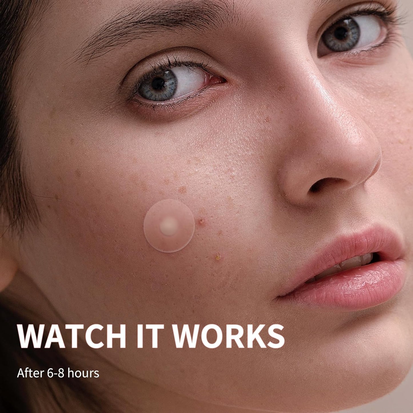 Acne™ Pimple Patch 72 Pcs