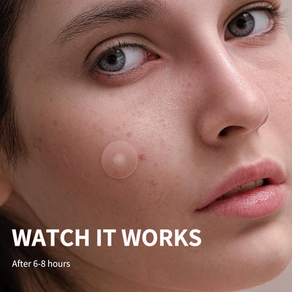 Acne™ Pimple Patch 72 Pcs